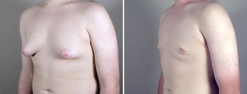Gynecomastia Reduction Patient 18