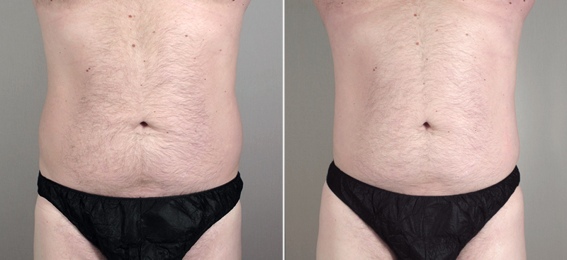 Male Liposuction Patient 11