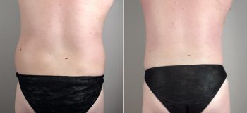 Male Liposuction Patient 11