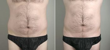 Male Liposuction Patient 10