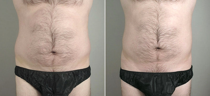 Male Liposuction Patient 10