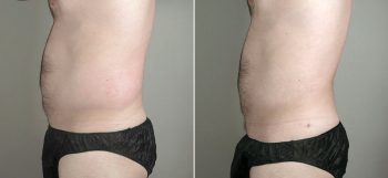 Male Liposuction Patient 10