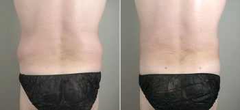 Male Liposuction Patient 10