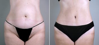 Mommy Makeover Patient 18