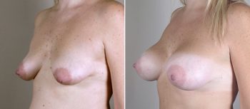 Mommy Makeover Patient 18