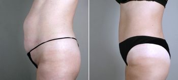 Mommy Makeover Patient 18