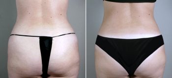 Mommy Makeover Patient 18