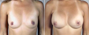 Mommy Makeover Patient 16