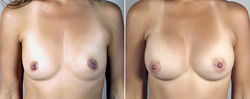 Mommy Makeover Patient 16