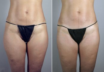 Mommy Makeover Patient 16