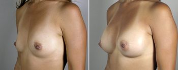 Mommy Makeover Patient 16