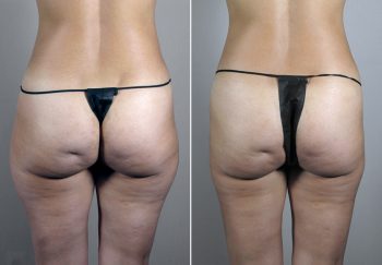 Mommy Makeover Patient 16