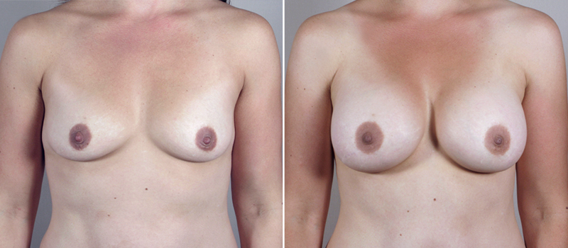 Mommy Makeover Patient 17