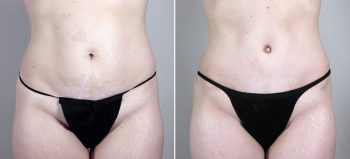 Mommy Makeover Patient 17