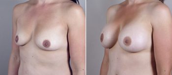 Mommy Makeover Patient 17