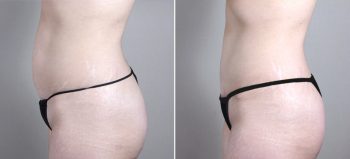 Mommy Makeover Patient 17