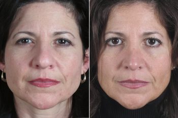 Rhinoplasty Patient 25