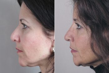 Rhinoplasty Patient 25