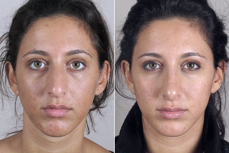 Rhinoplasty Patient 24