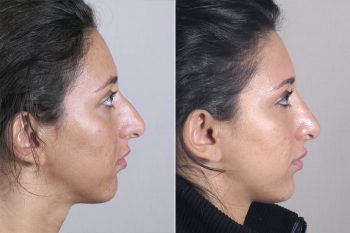 Rhinoplasty Patient 24