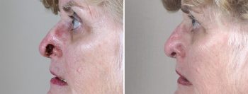 Skin Cancer Treatment Patient 21