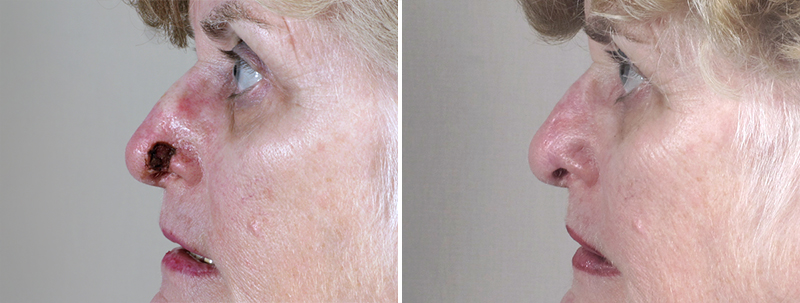 Skin Cancer Treatment Patient 21