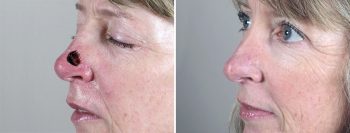 Skin Cancer Treatment Patient 20