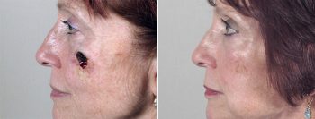 Skin Cancer Treatment Patient 22