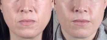 Facial Fillers Patient 7 – Fat Injection