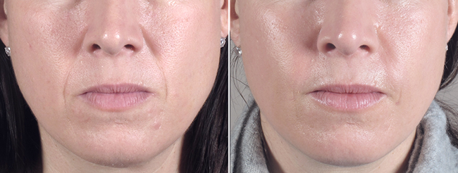 Facial Fillers Patient 7 – Fat Injection