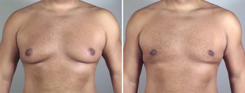Gynecomastia Reduction Patient 19