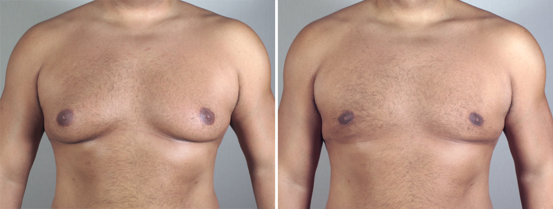 Gynecomastia Reduction Patient 19