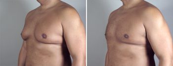 Gynecomastia Reduction Patient 19