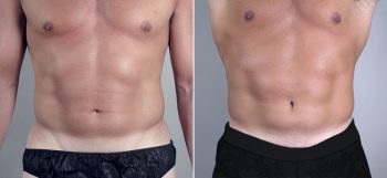 Male Liposuction Patient 12