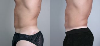 Male Liposuction Patient 12