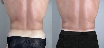 Male Liposuction Patient 12