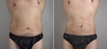 Male Liposuction Patient 13
