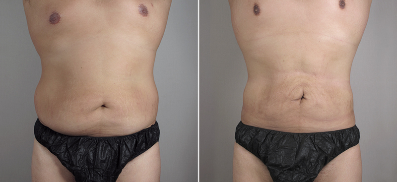 Male Liposuction Patient 13