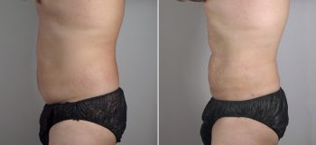 Male Liposuction Patient 13