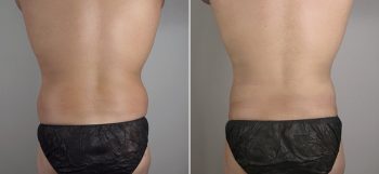 Male Liposuction Patient 13