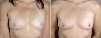 Inverted Nipple Correction Patient 6