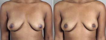 Inverted Nipple Correction Patient 5
