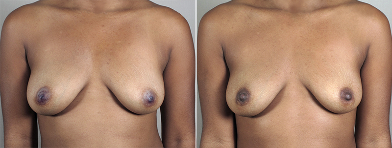 Inverted Nipple Correction Patient 5