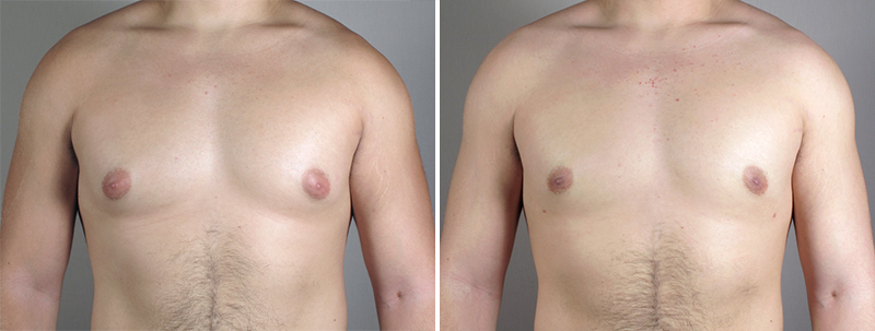 male-gynecomastia-4a Breast Reduction for Men New Jersey Photo