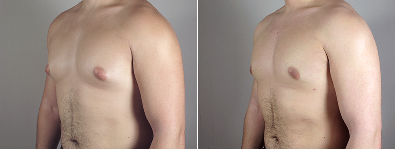 male-gynecomastia-4b Breast Reduction for Men New Jersey Photo