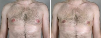 Gynecomastia Reduction Patient 21