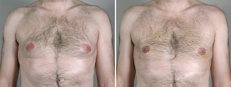 Gynecomastia Reduction Patient 21