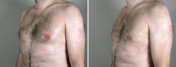 Gynecomastia Reduction Patient 21