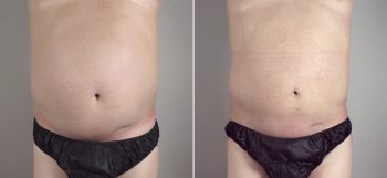 Male Liposuction Patient 14