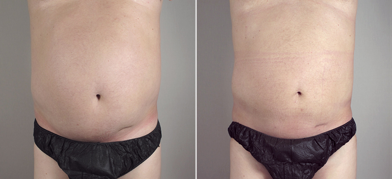 Male Liposuction Patient 14